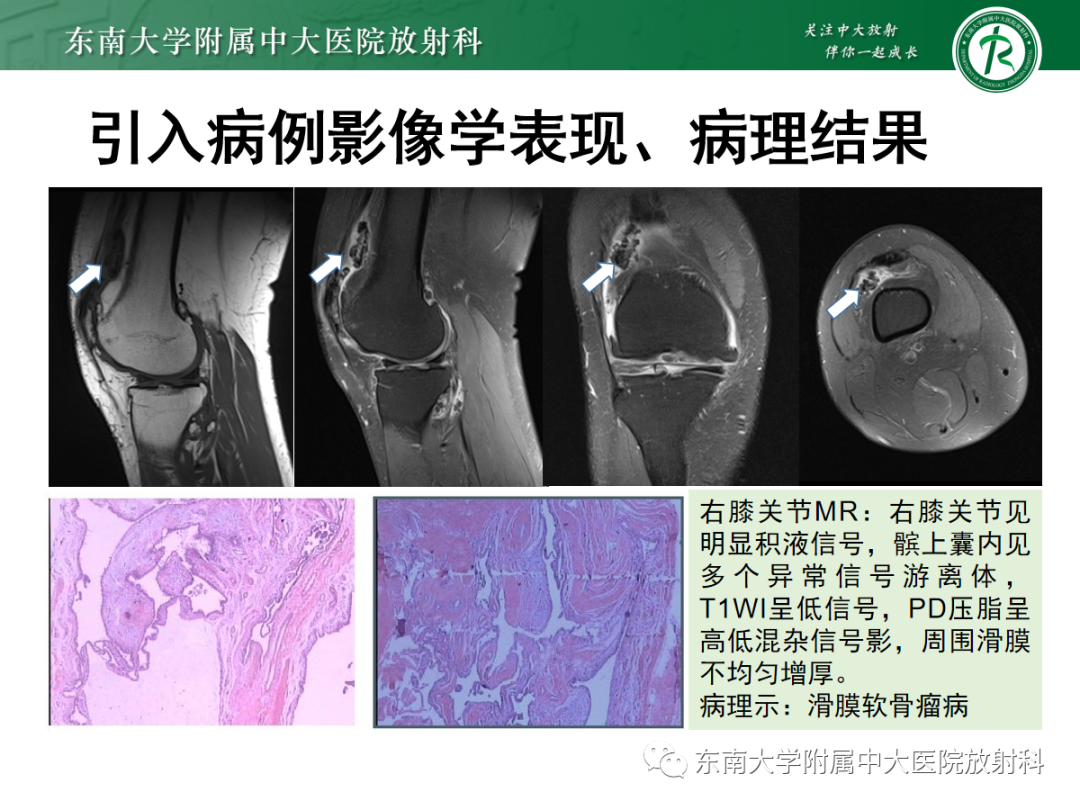 影像PPT - 【PPT】滑膜骨软骨瘤病-2 影像PPT - 【PPT】滑膜骨软骨瘤病-2