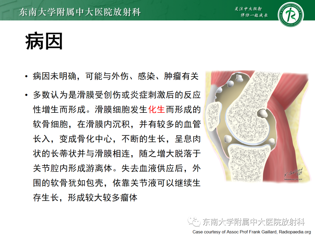 影像PPT - 【PPT】滑膜骨软骨瘤病-5 影像PPT - 【PPT】滑膜骨软骨瘤病-5