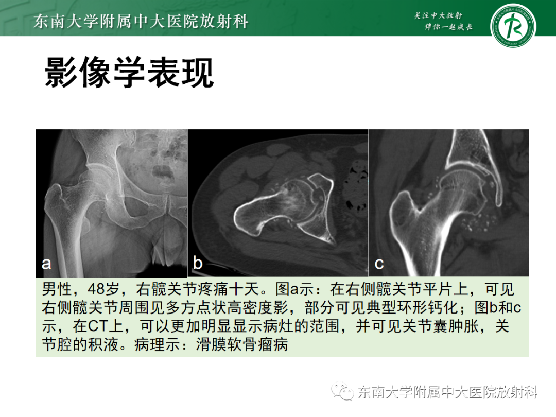 影像PPT - 【PPT】滑膜骨软骨瘤病-9 影像PPT - 【PPT】滑膜骨软骨瘤病-9
