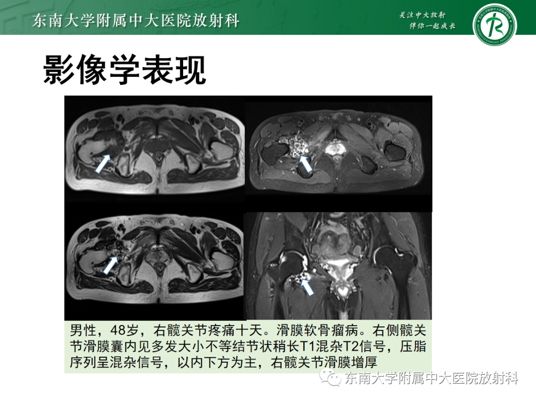 影像PPT - 【PPT】滑膜骨软骨瘤病-10 影像PPT - 【PPT】滑膜骨软骨瘤病-10
