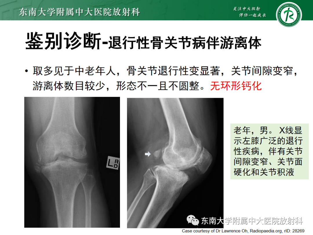 影像PPT - 【PPT】滑膜骨软骨瘤病-11 影像PPT - 【PPT】滑膜骨软骨瘤病-11