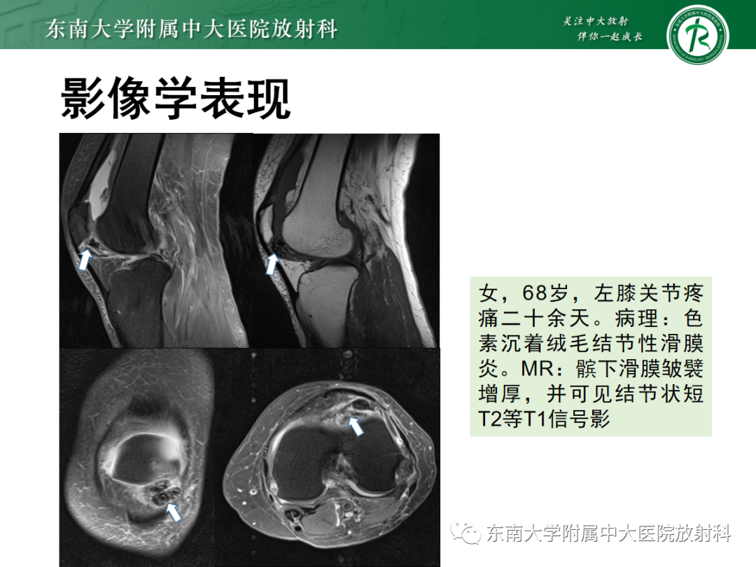影像PPT - 【PPT】滑膜骨软骨瘤病-13 影像PPT - 【PPT】滑膜骨软骨瘤病-13