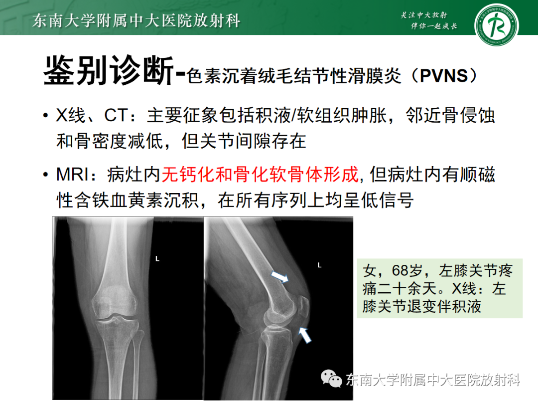影像PPT - 【PPT】滑膜骨软骨瘤病-12 影像PPT - 【PPT】滑膜骨软骨瘤病-12