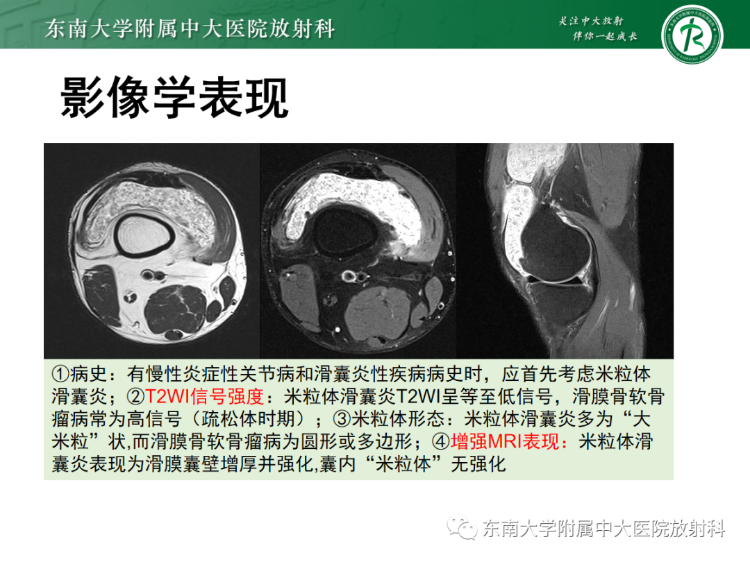 影像PPT - 【PPT】滑膜骨软骨瘤病-18 影像PPT - 【PPT】滑膜骨软骨瘤病-18