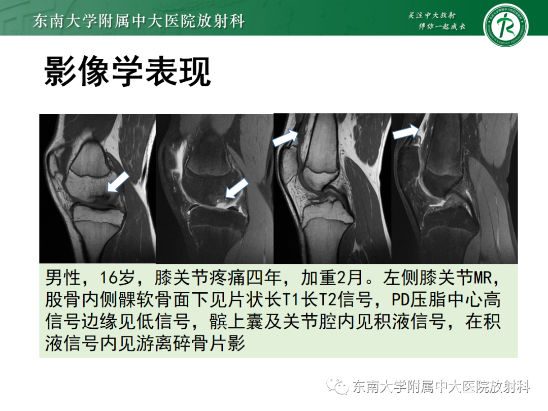 影像PPT - 【PPT】滑膜骨软骨瘤病-15 影像PPT - 【PPT】滑膜骨软骨瘤病-15