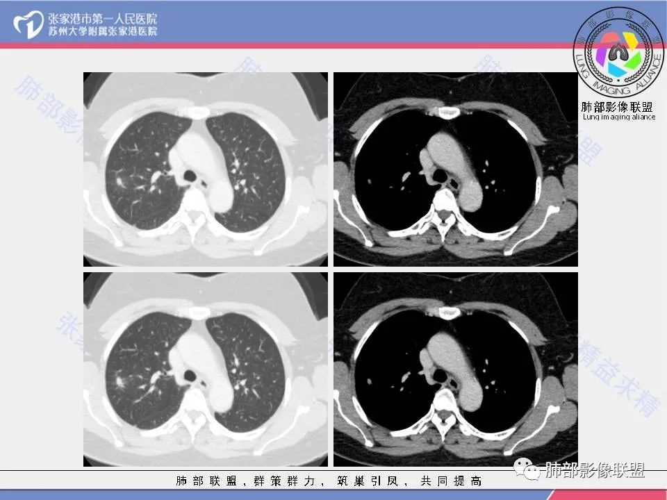 影像PPT - 【病例】肺炎性肉芽肿1例CT影像-5 影像PPT - 【病例】肺炎性肉芽肿1例CT影像-5