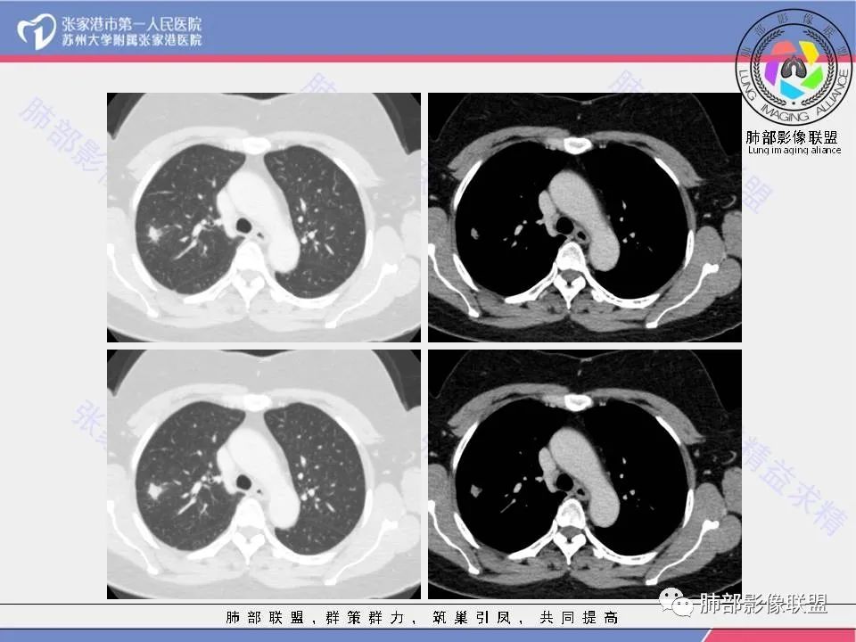 影像PPT - 【病例】肺炎性肉芽肿1例CT影像-6 影像PPT - 【病例】肺炎性肉芽肿1例CT影像-6