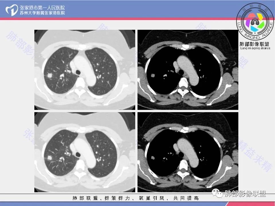 影像PPT - 【病例】肺炎性肉芽肿1例CT影像-8 影像PPT - 【病例】肺炎性肉芽肿1例CT影像-8