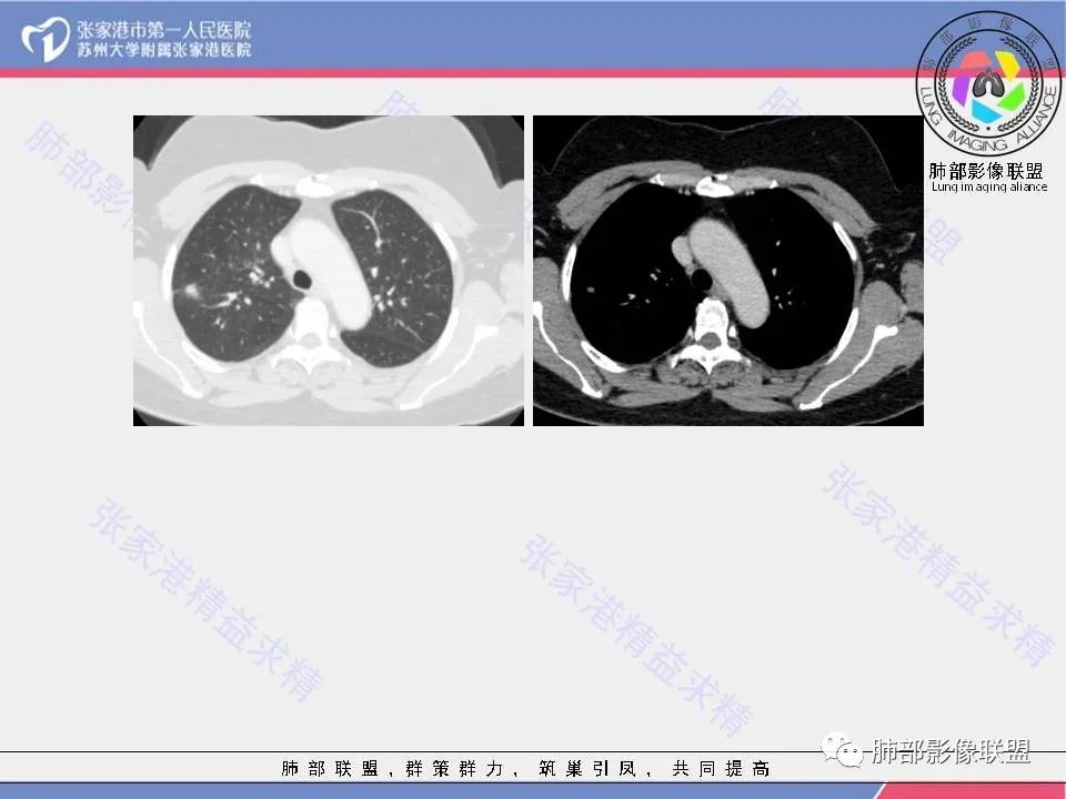影像PPT - 【病例】肺炎性肉芽肿1例CT影像-9 影像PPT - 【病例】肺炎性肉芽肿1例CT影像-9