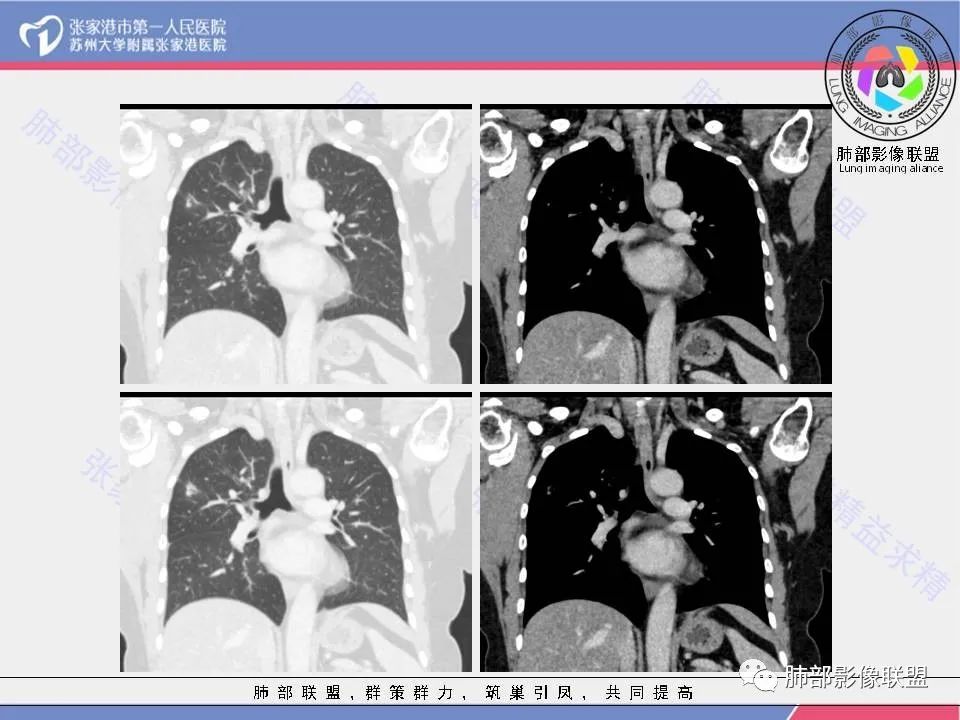 影像PPT - 【病例】肺炎性肉芽肿1例CT影像-11 影像PPT - 【病例】肺炎性肉芽肿1例CT影像-11