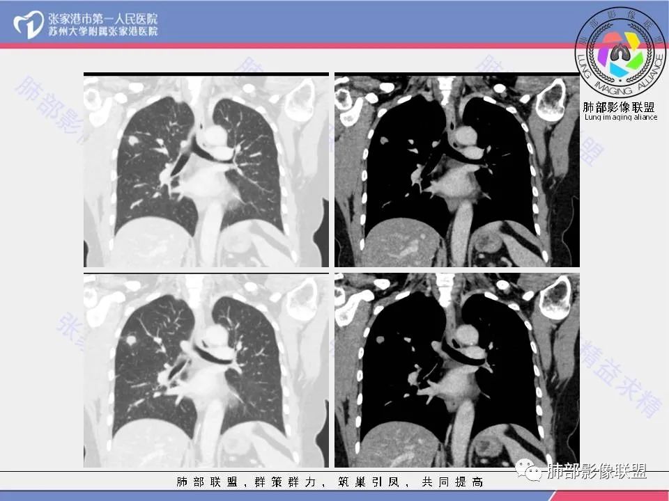 影像PPT - 【病例】肺炎性肉芽肿1例CT影像-13 影像PPT - 【病例】肺炎性肉芽肿1例CT影像-13