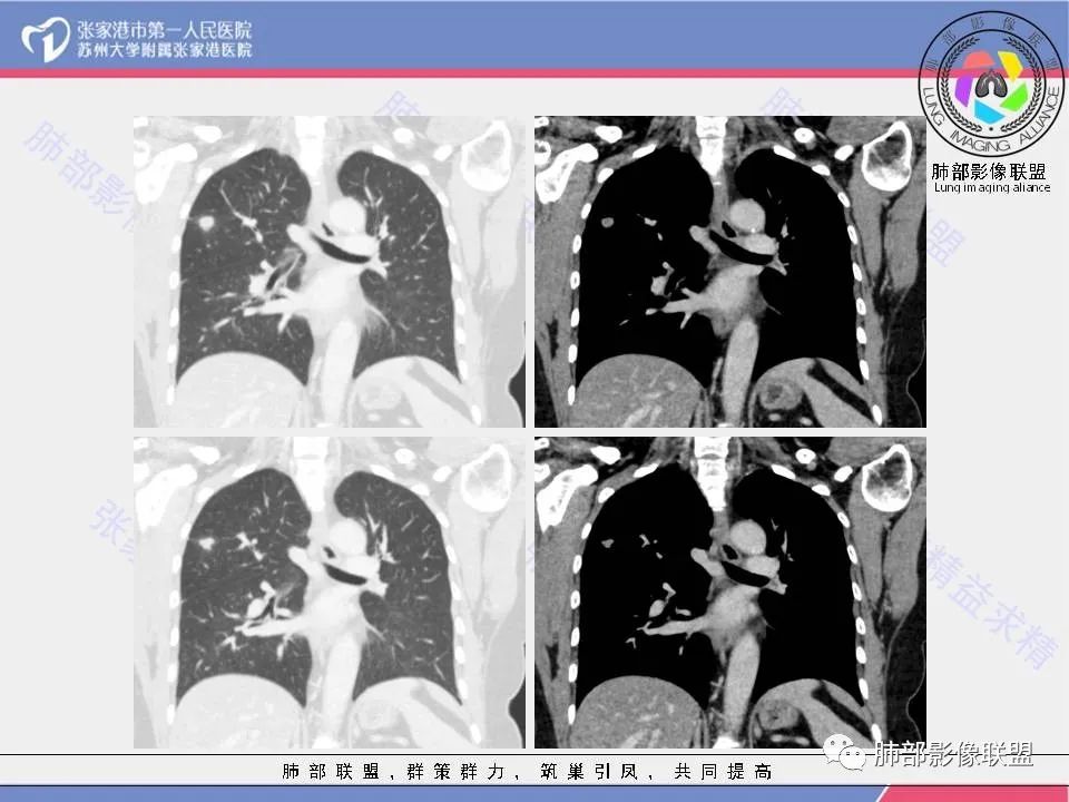 影像PPT - 【病例】肺炎性肉芽肿1例CT影像-14 影像PPT - 【病例】肺炎性肉芽肿1例CT影像-14