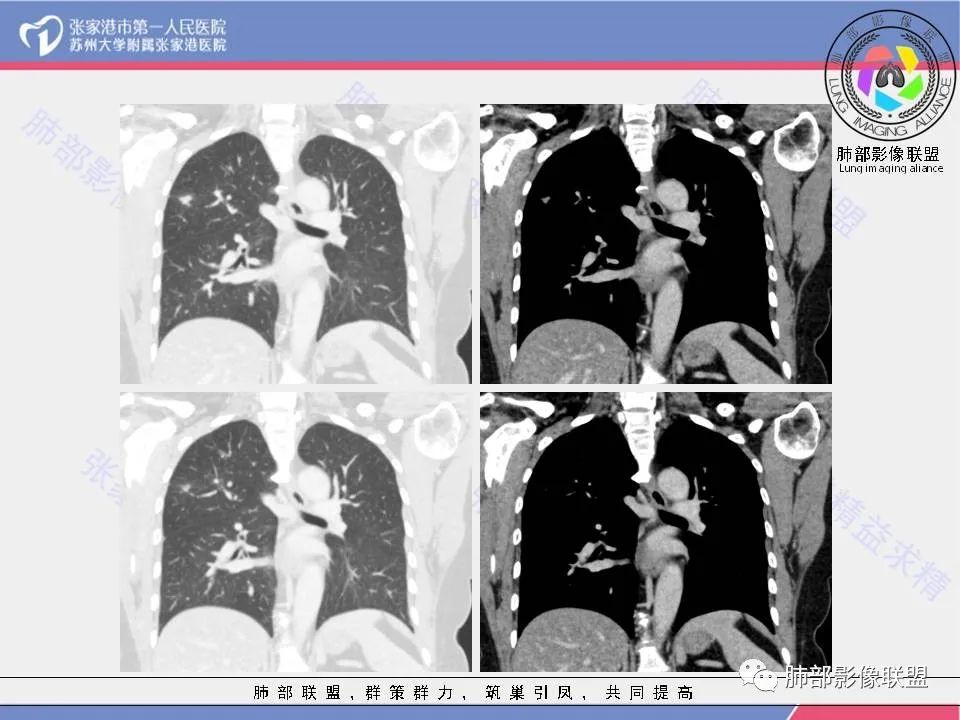 影像PPT - 【病例】肺炎性肉芽肿1例CT影像-15 影像PPT - 【病例】肺炎性肉芽肿1例CT影像-15