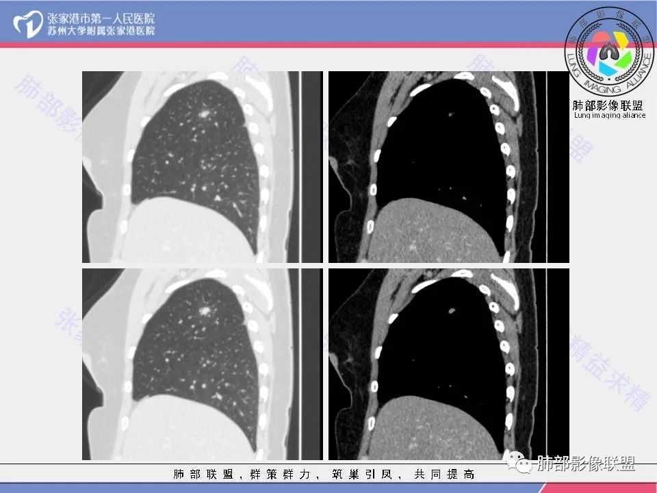 影像PPT - 【病例】肺炎性肉芽肿1例CT影像-16 影像PPT - 【病例】肺炎性肉芽肿1例CT影像-16