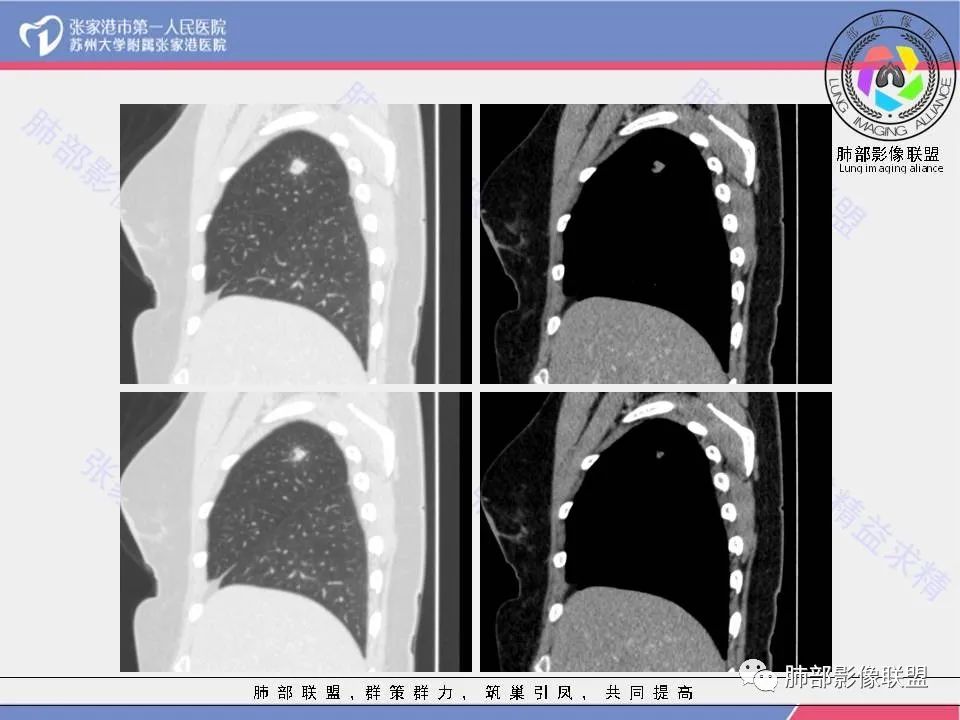 影像PPT - 【病例】肺炎性肉芽肿1例CT影像-19 影像PPT - 【病例】肺炎性肉芽肿1例CT影像-19