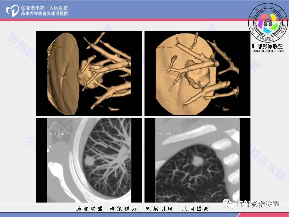影像PPT - 【病例】肺炎性肉芽肿1例CT影像-20 影像PPT - 【病例】肺炎性肉芽肿1例CT影像-20