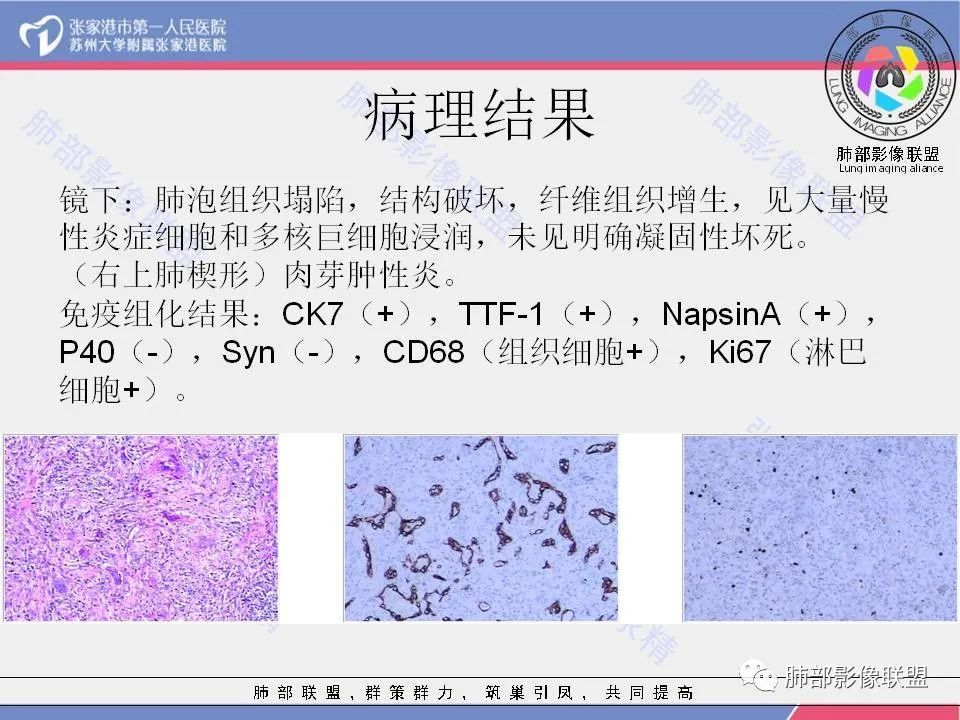 影像PPT - 【病例】肺炎性肉芽肿1例CT影像-21 影像PPT - 【病例】肺炎性肉芽肿1例CT影像-21