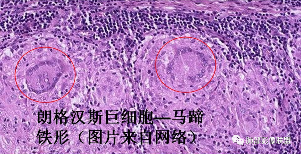 影像PPT - 【病例】肺炎性肉芽肿1例CT影像-22 影像PPT - 【病例】肺炎性肉芽肿1例CT影像-22