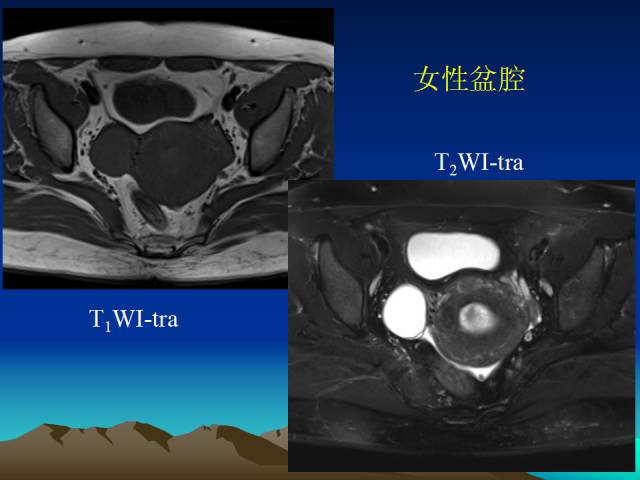影像PPT - 【PPT】子宫常见疾病的MRI诊断-6