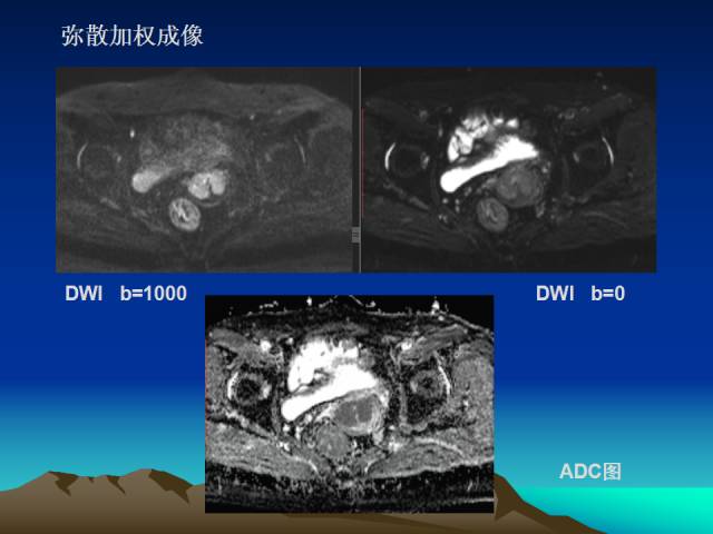 影像PPT - 【PPT】子宫常见疾病的MRI诊断-9