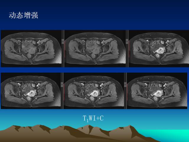 影像PPT - 【PPT】子宫常见疾病的MRI诊断-10
