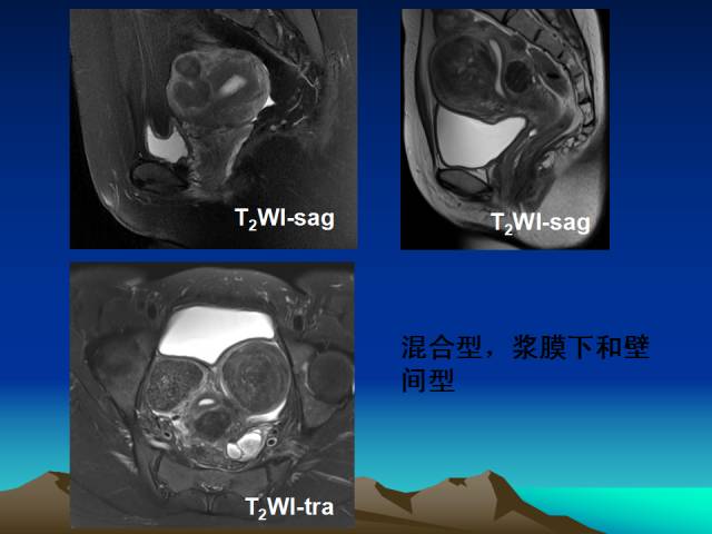 影像PPT - 【PPT】子宫常见疾病的MRI诊断-15