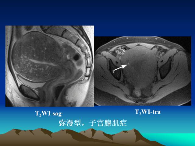 影像PPT - 【PPT】子宫常见疾病的MRI诊断-21