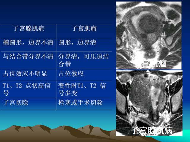 影像PPT - 【PPT】子宫常见疾病的MRI诊断-22