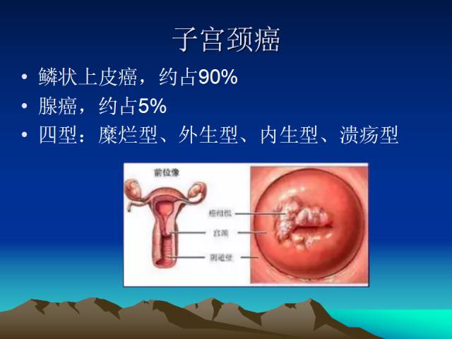 影像PPT - 【PPT】子宫常见疾病的MRI诊断-24