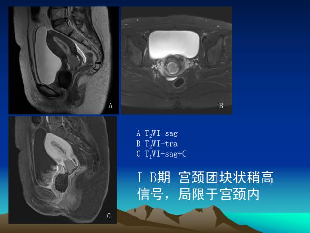 影像PPT - 【PPT】子宫常见疾病的MRI诊断-27