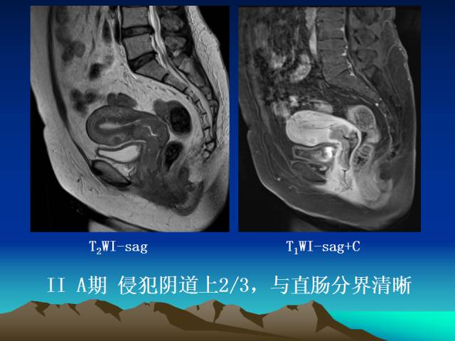 影像PPT - 【PPT】子宫常见疾病的MRI诊断-29
