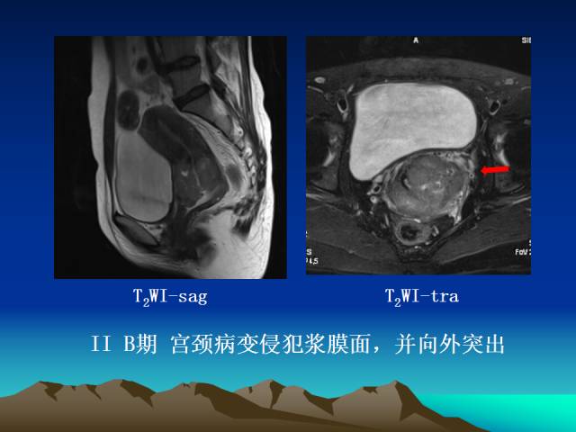 影像PPT - 【PPT】子宫常见疾病的MRI诊断-30