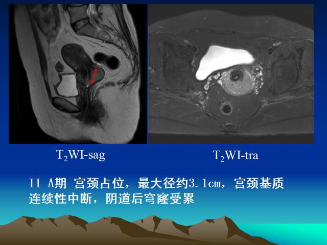 影像PPT - 【PPT】子宫常见疾病的MRI诊断-28