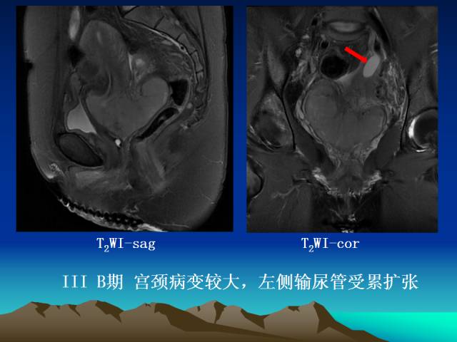 影像PPT - 【PPT】子宫常见疾病的MRI诊断-32