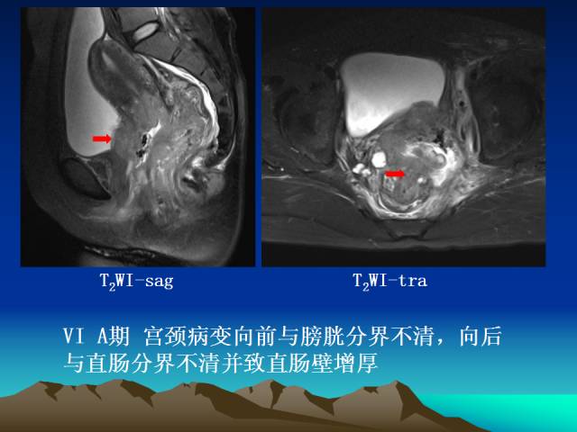 影像PPT - 【PPT】子宫常见疾病的MRI诊断-33
