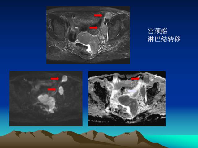 影像PPT - 【PPT】子宫常见疾病的MRI诊断-36