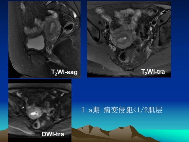 影像PPT - 【PPT】子宫常见疾病的MRI诊断-42