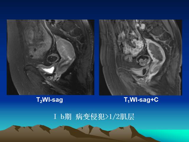 影像PPT - 【PPT】子宫常见疾病的MRI诊断-43
