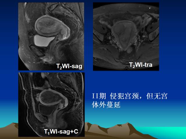 影像PPT - 【PPT】子宫常见疾病的MRI诊断-45