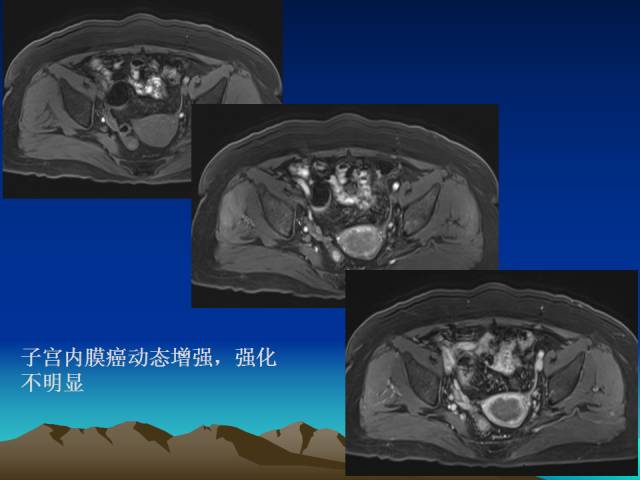 影像PPT - 【PPT】子宫常见疾病的MRI诊断-44