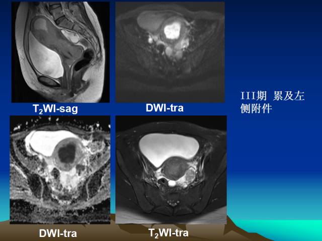 影像PPT - 【PPT】子宫常见疾病的MRI诊断-46