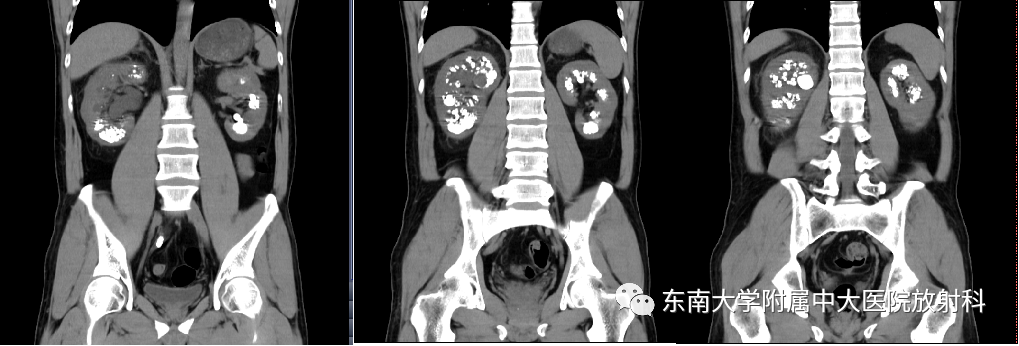 影像PPT - 【PPT】髓质海绵肾-2