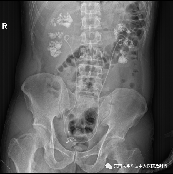 影像PPT - 【PPT】髓质海绵肾-3