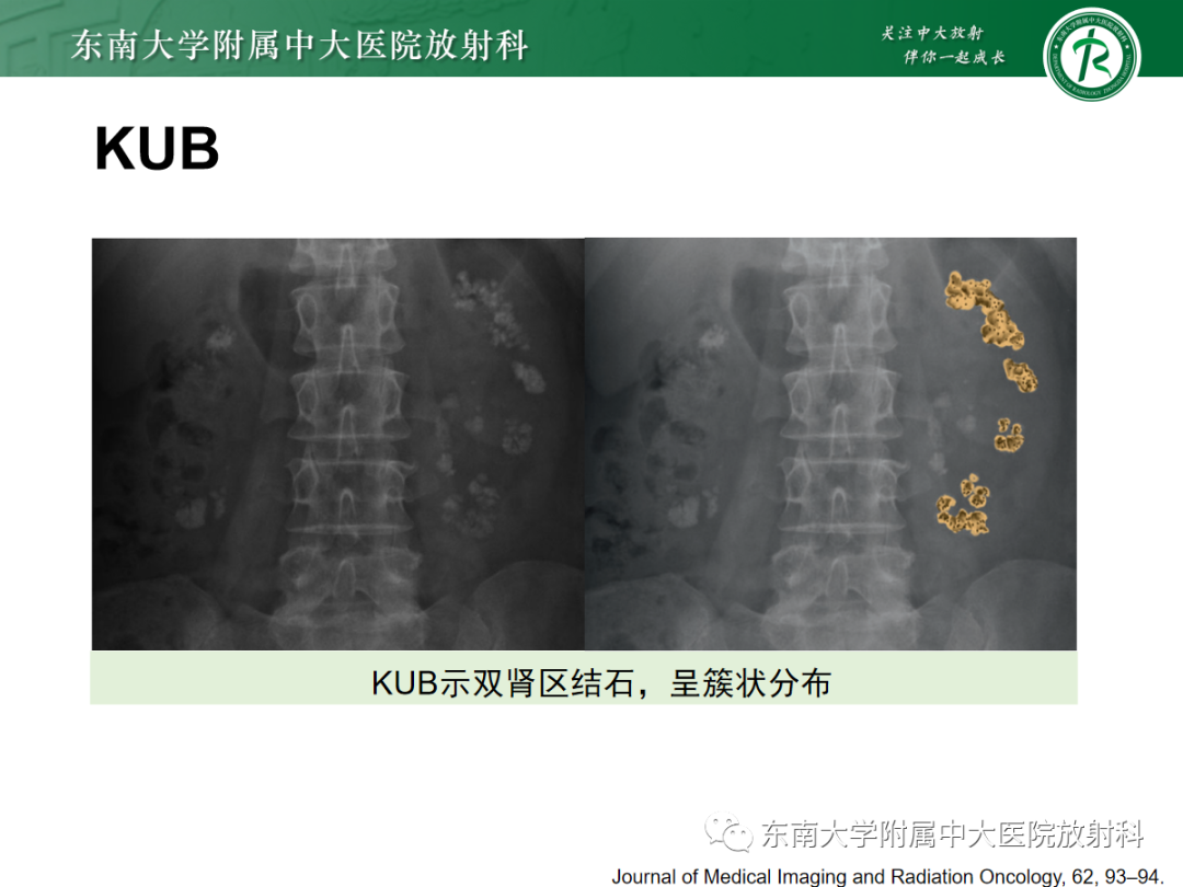 影像PPT - 【PPT】髓质海绵肾-12