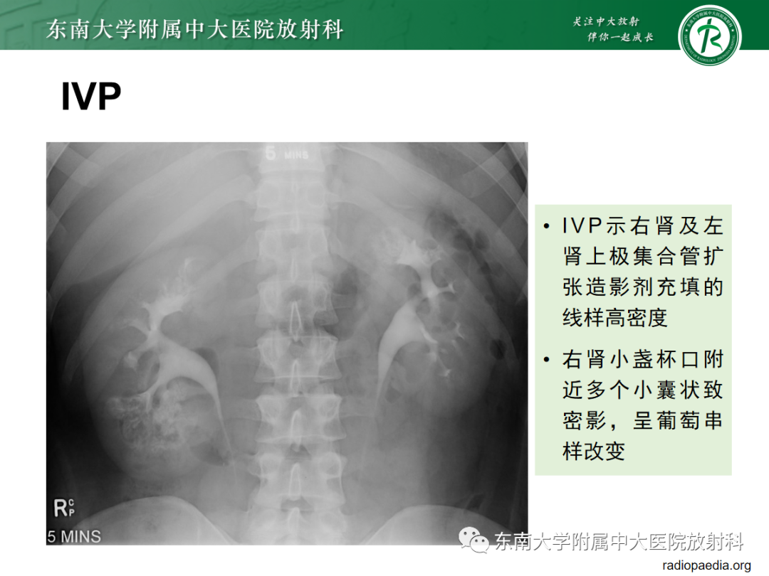 影像PPT - 【PPT】髓质海绵肾-14