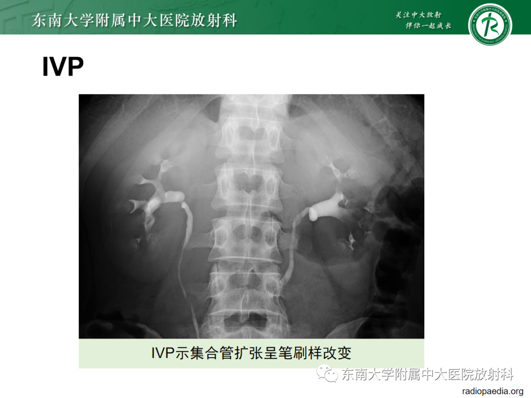 影像PPT - 【PPT】髓质海绵肾-16