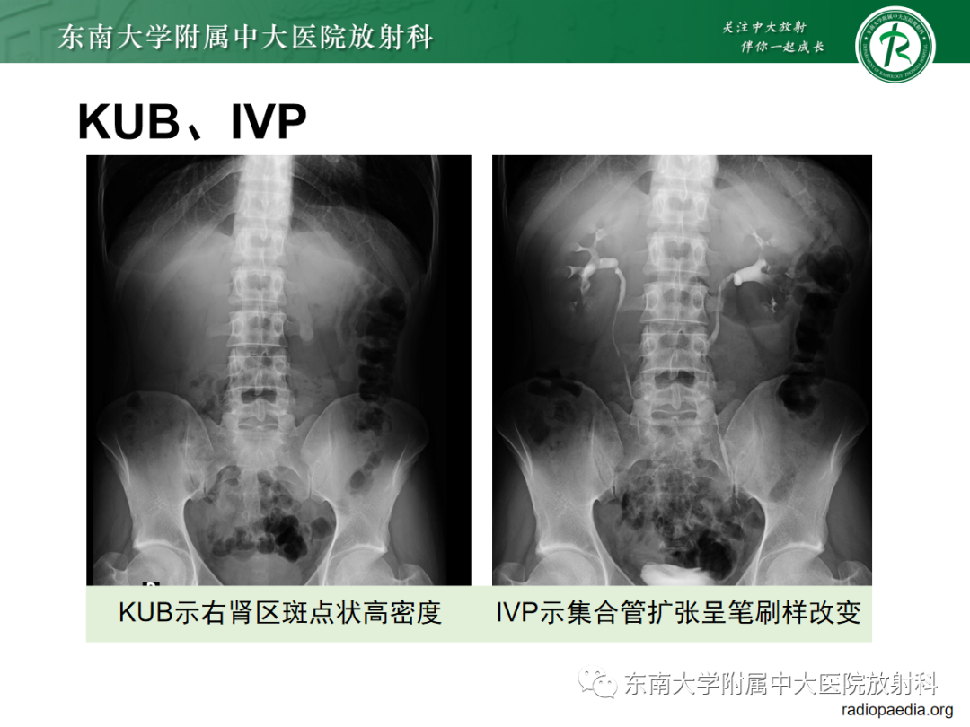 影像PPT - 【PPT】髓质海绵肾-15