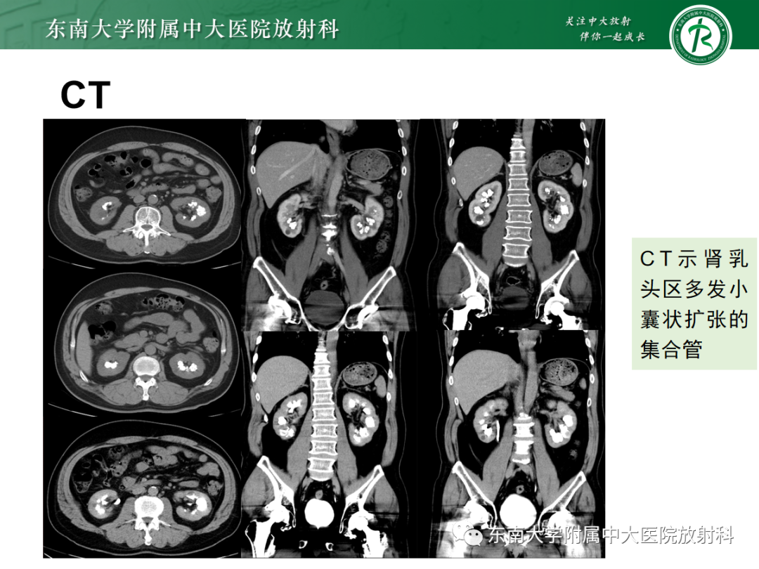 影像PPT - 【PPT】髓质海绵肾-19
