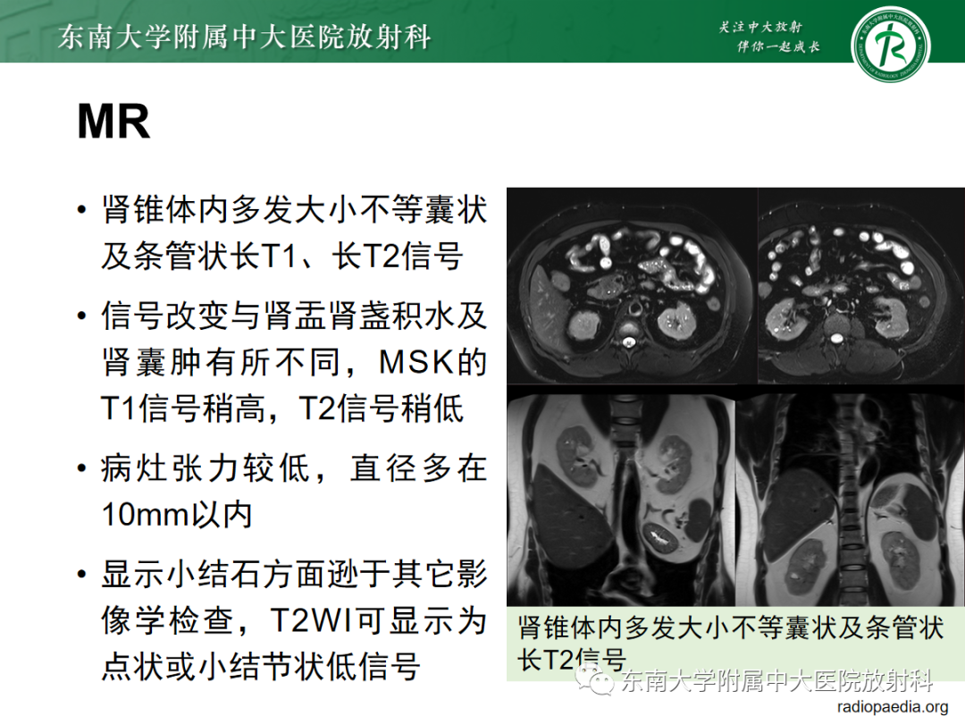 影像PPT - 【PPT】髓质海绵肾-20