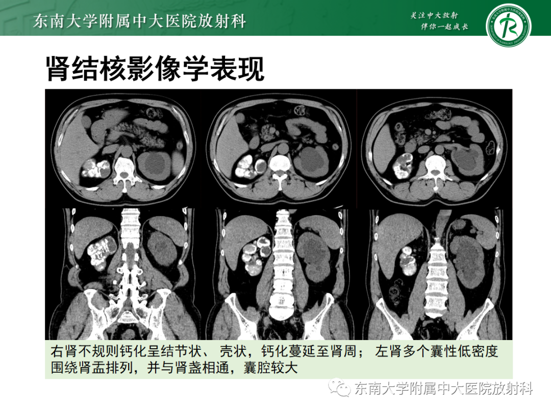 影像PPT - 【PPT】髓质海绵肾-23